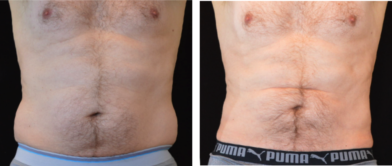 before and after trunk lipo – BuildMyHealth