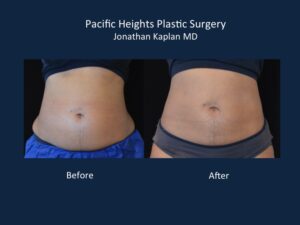 CoolSculpting abdomen before and after – BuildMyHealth