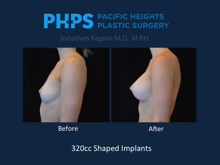 32AA to 32C, Over the Muscle, Saline Ideal Implant, 290cc/340cc 