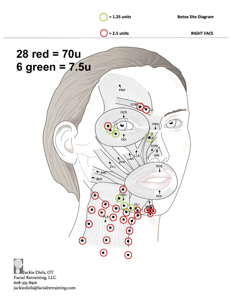 Bell's Palsy