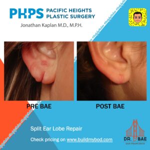 ear lobe surgery