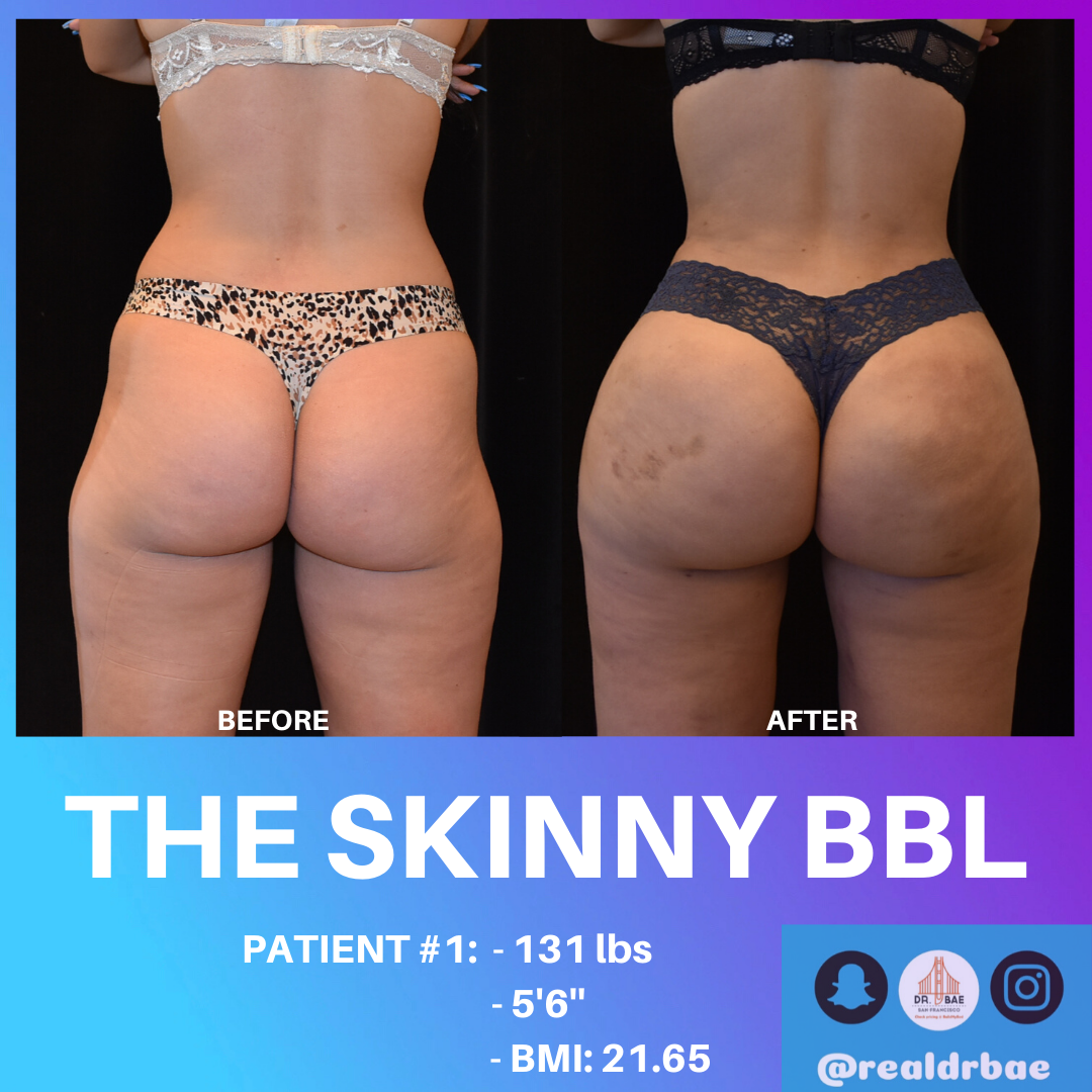 What Is The Skinny Brazilian Buttock Lift